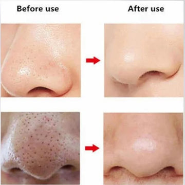 Blackhead Remover Vacuum | FPLS-001 | Deep Pore Cleansing Device